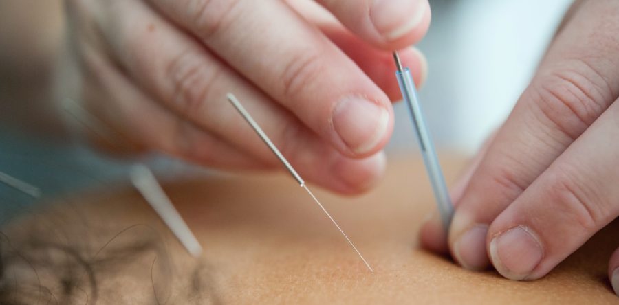 What You Need to Know about Acupuncture for Lower Back Pain