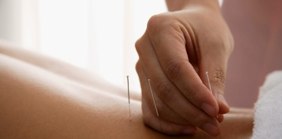 Dry Needling vs. Acupuncture: What’s the Difference?